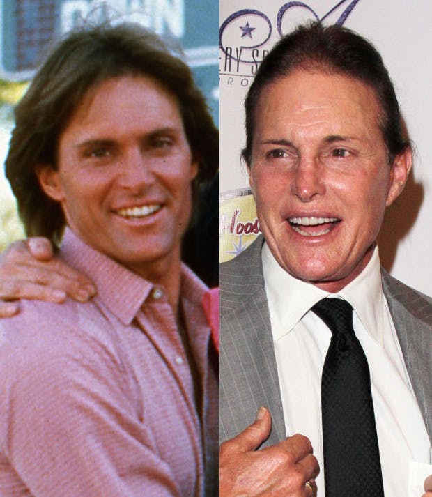 Plastic surgery timeline – the changing face of Bruce Jenner