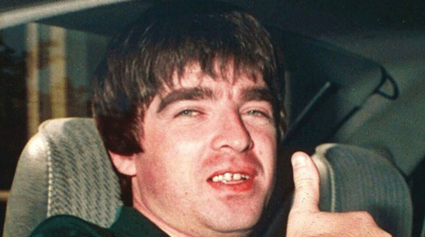 Noel-Gallagher-Oasis-teeth-before