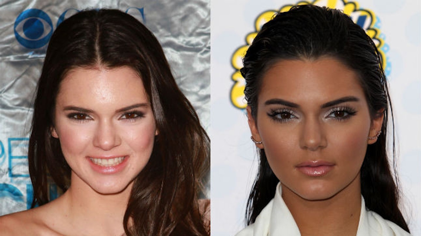 Kendall Jenner before and after surgery