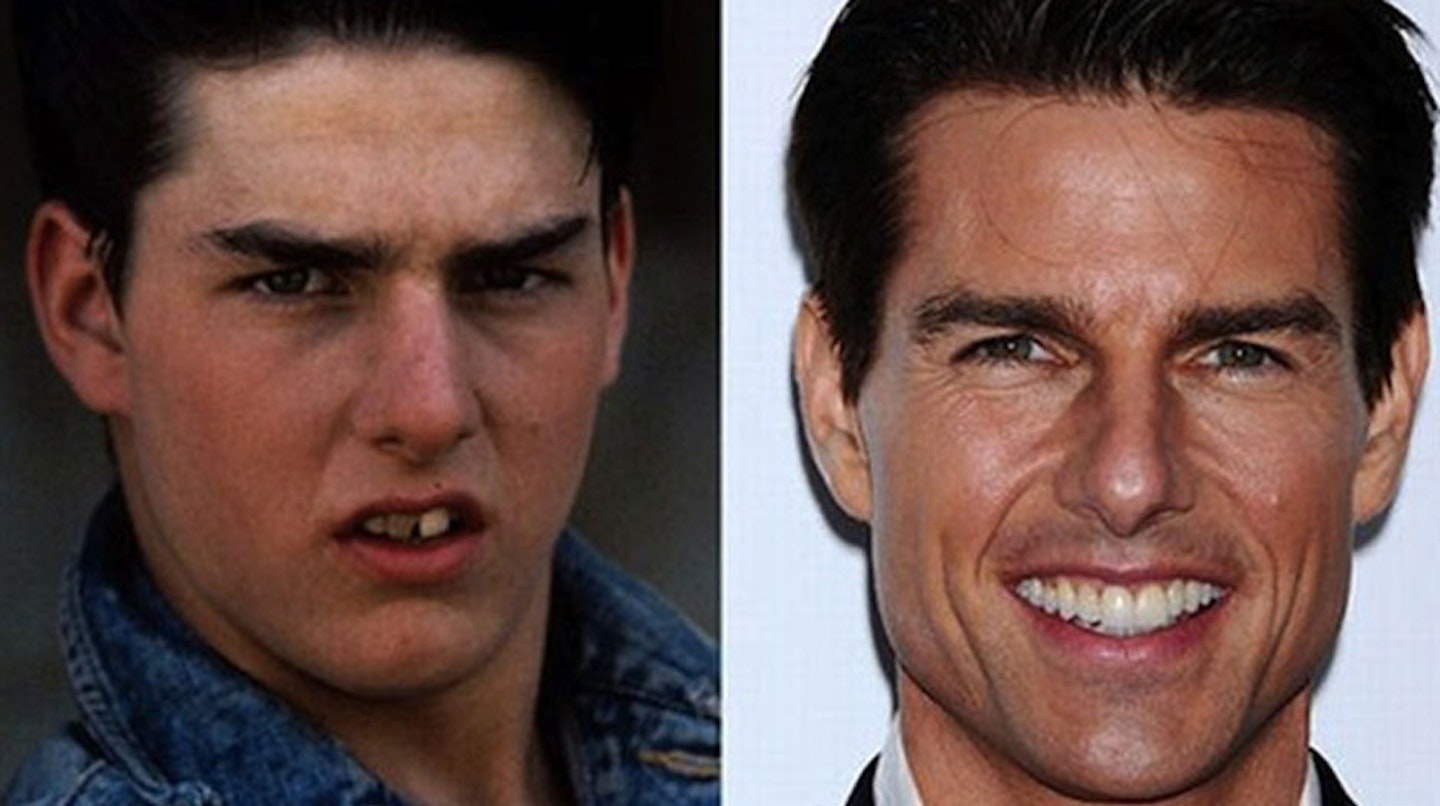 Tom-Cruise-before-after-teeth-surgery