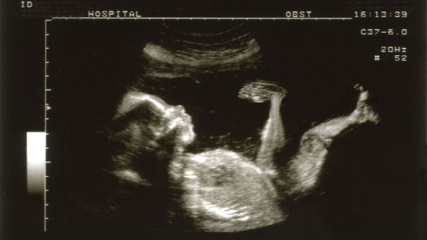 Pulmonary hypertension can lead to the sudden death of a woman during childbirth