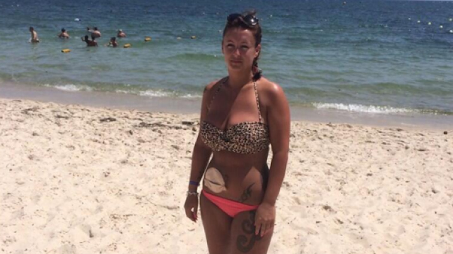 Mum with stoma bag shares bikini pictures to celebrate 'second chance at  life