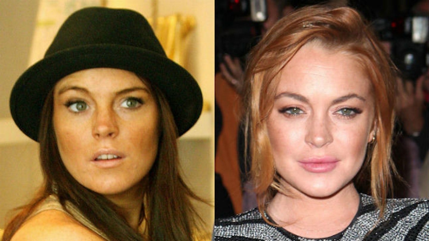lindsay lohan before and after surgery