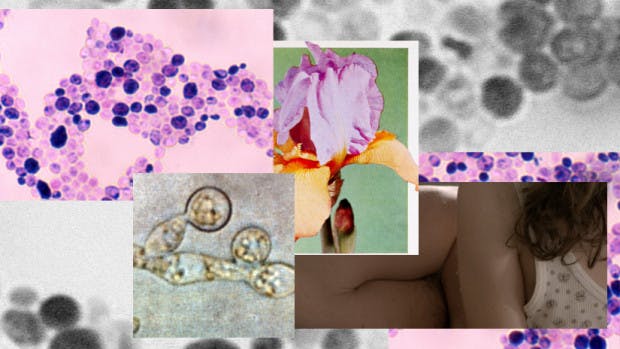 Could This Sexually Transmitted Yeast Infection Be Affecting People’s