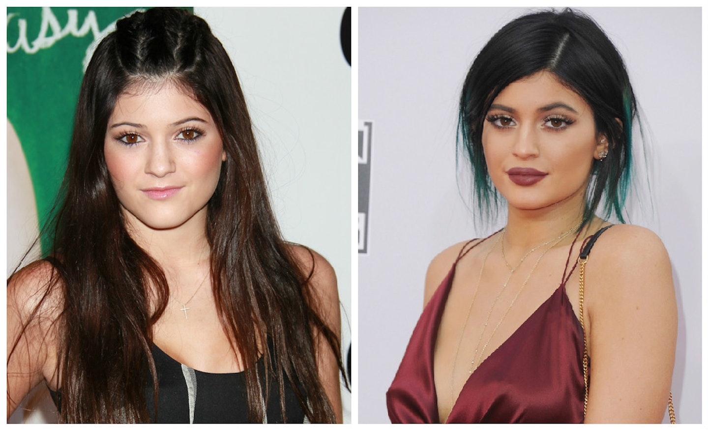 Kylie before and after injections via Getty