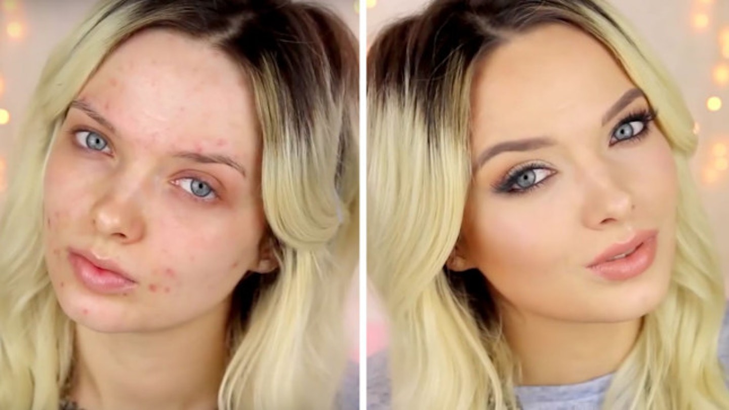 VIDEO: How to cover acne with makeup