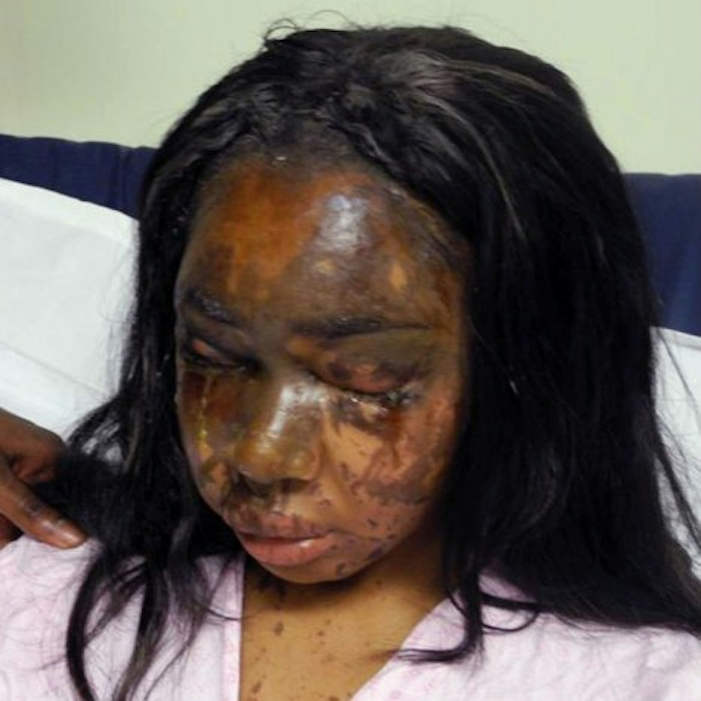 Naomi released pictures of her face and chest following the attack