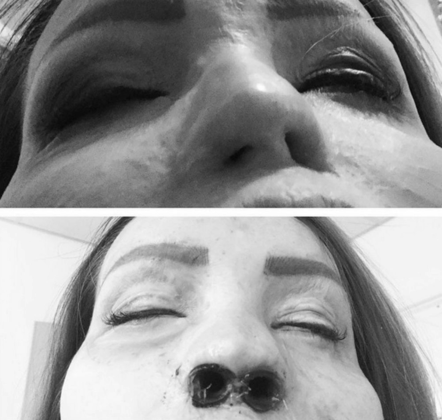 katie-piper-nose-operation-before-after