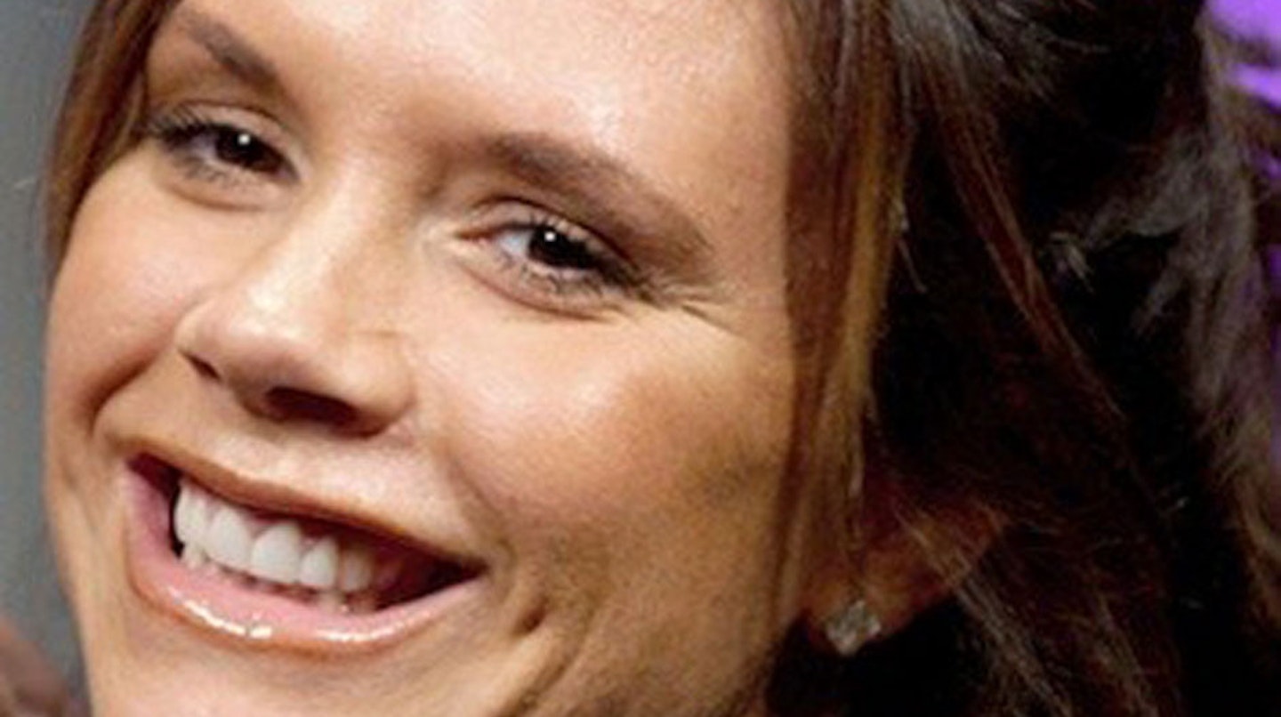 Victoria-Beckham-teeth-surgery-picture