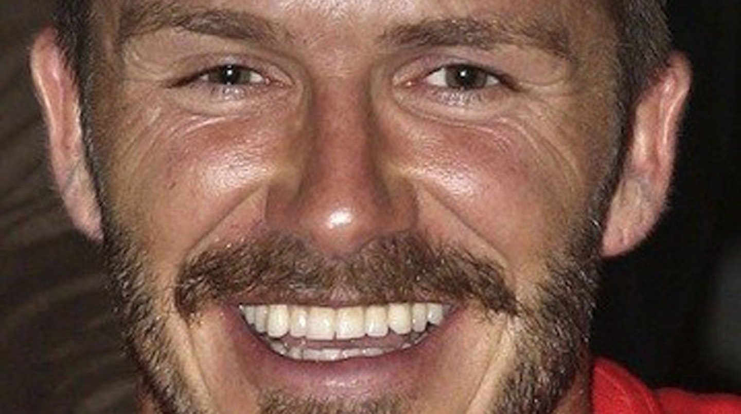 David-Beckham-teeth-after-veneers