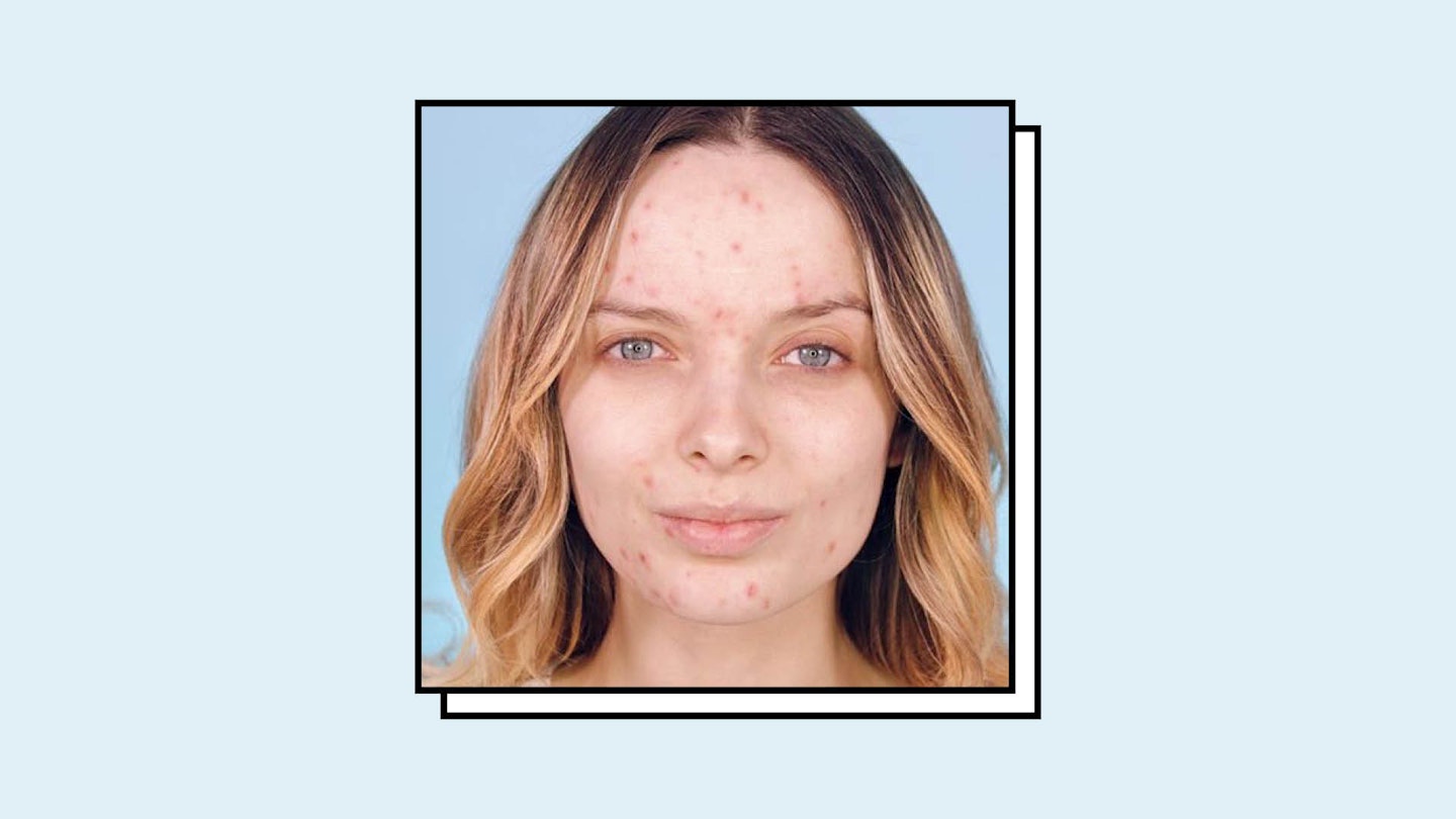 Acne Selfies Are Taking Over Our Instagram Feeds, And It's About Time