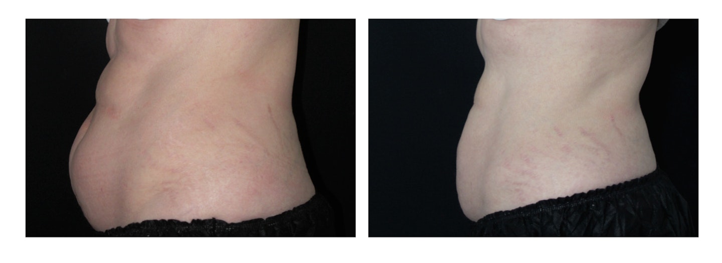 Cool Sculpting