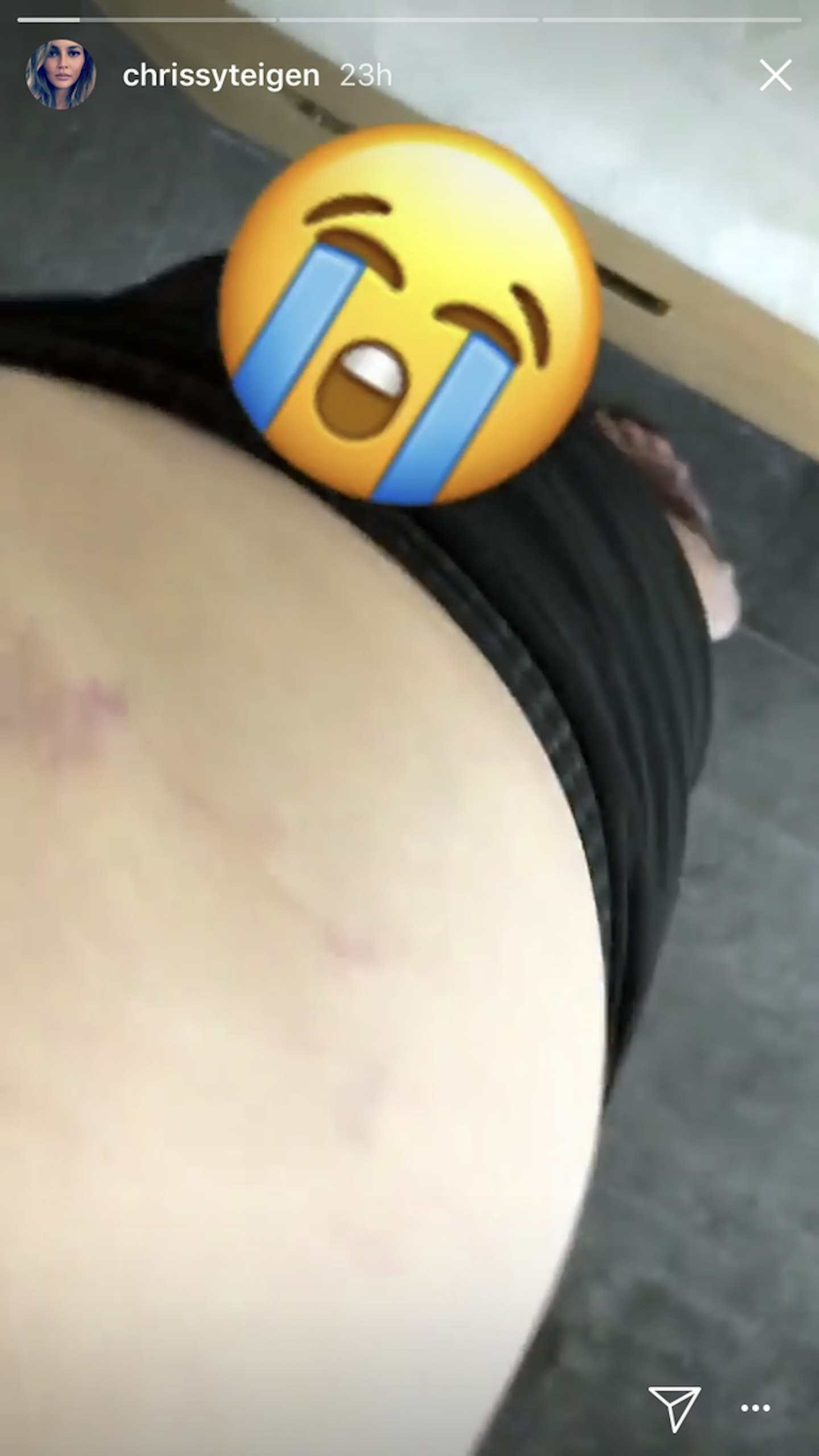 Chrissy Teigen stretch marks