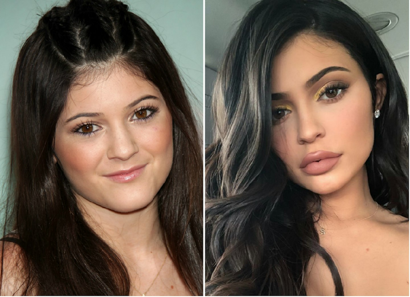 Kylie Jenner before and after plastic surgery