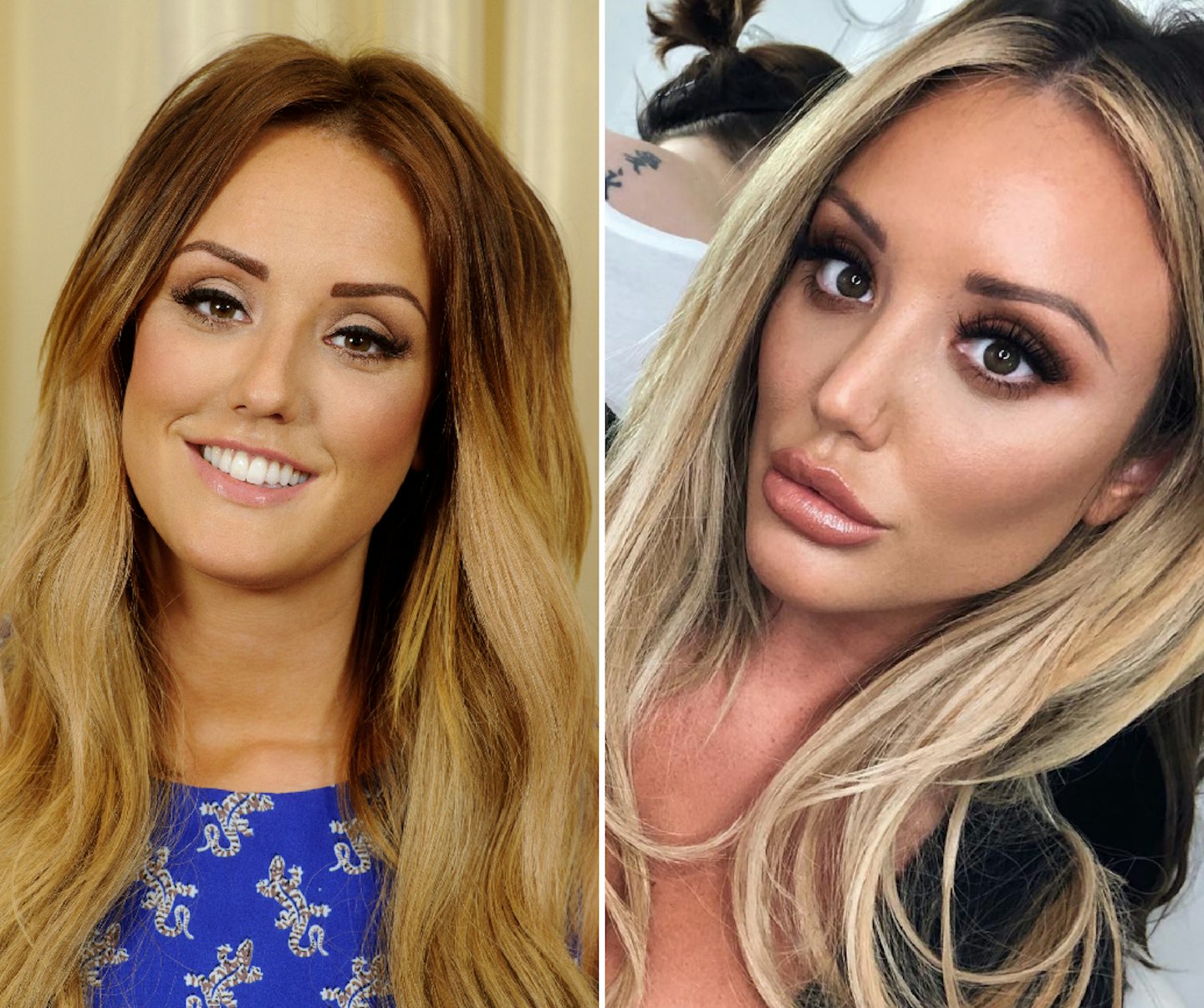 Charlotte Crosby before and after plastic surgery