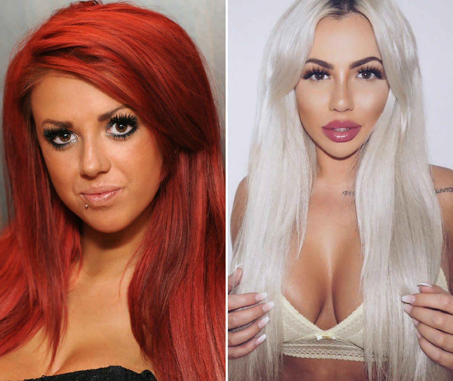 Holly Hagan before and after plastic surgery