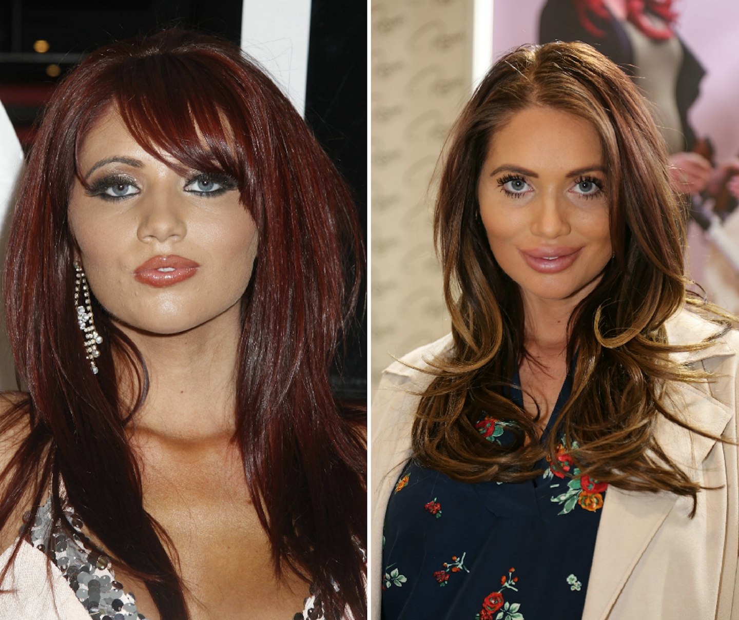 Amy Childs before and after plastic surgery