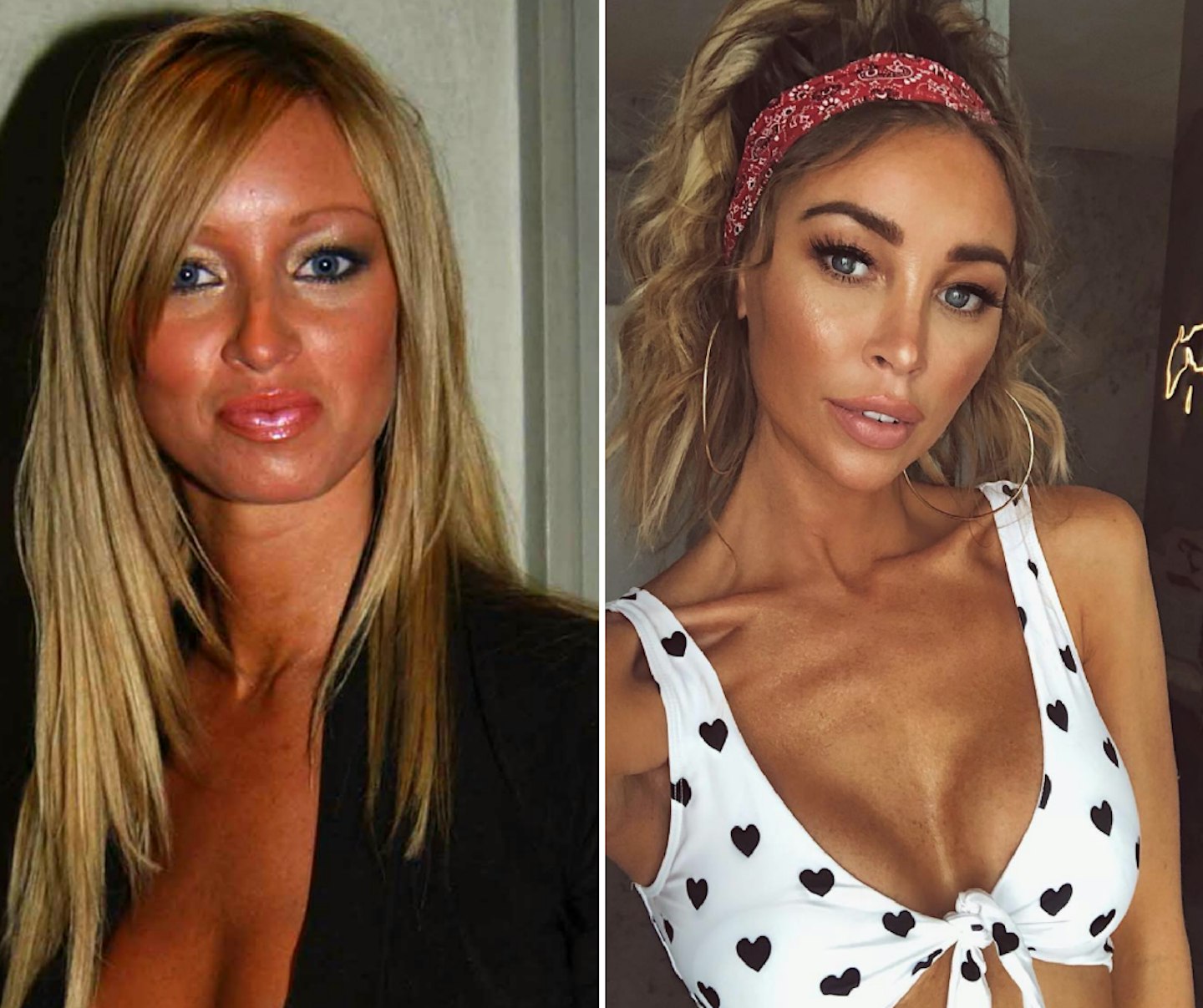 Lauren Pope before and after plastic surgery