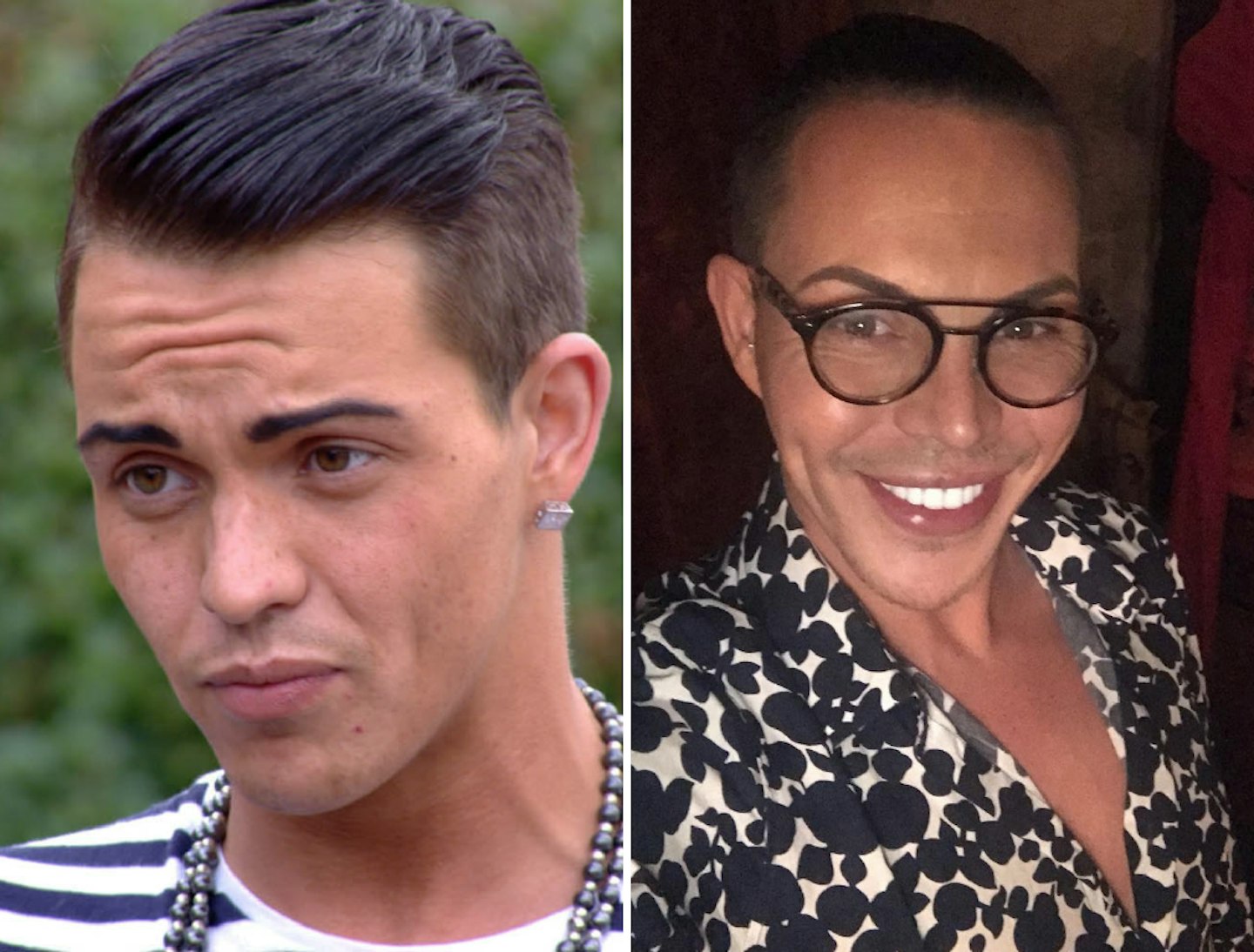Bobby Norris before and after plastic surgery
