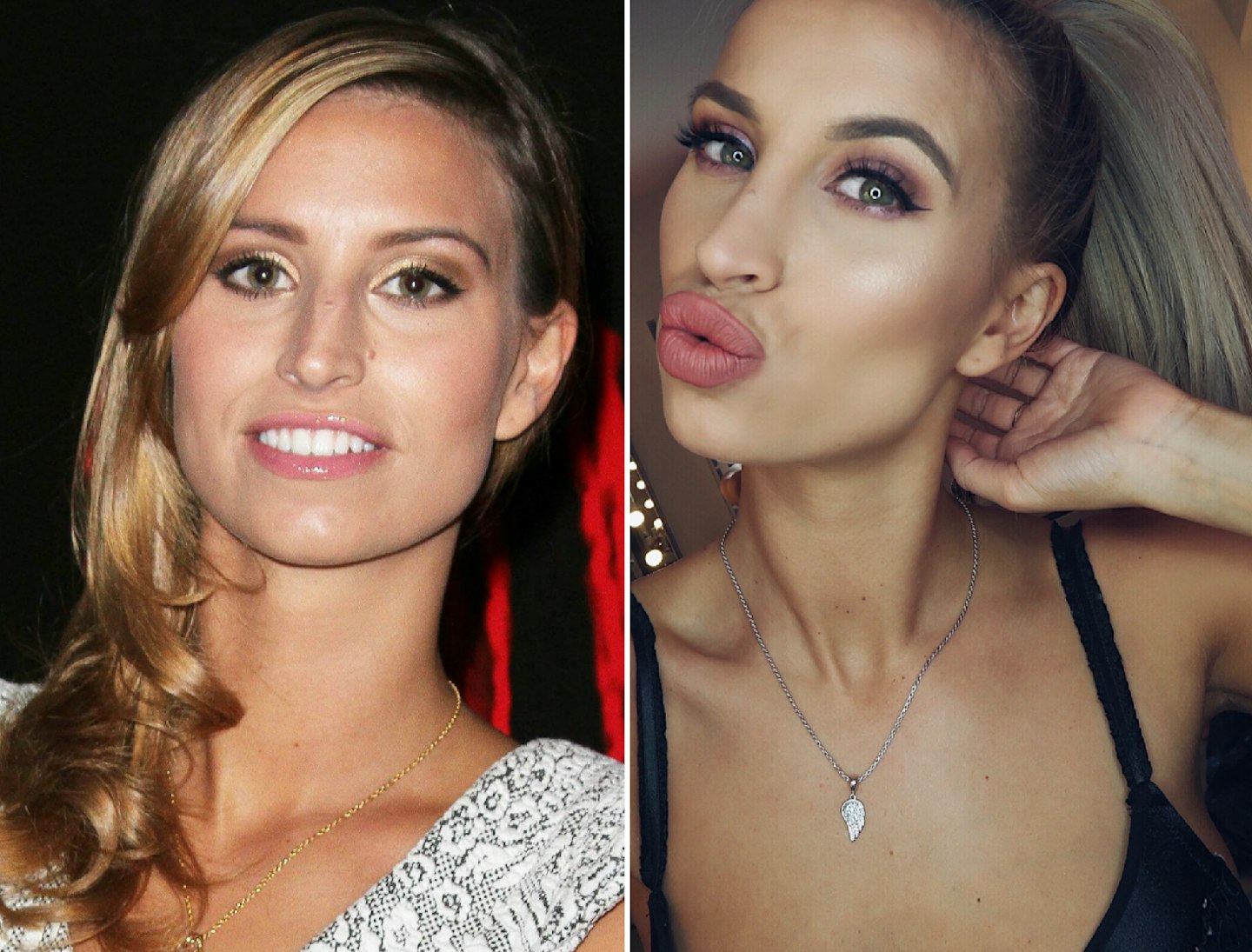 Ferne McCann before and after plastic surgery