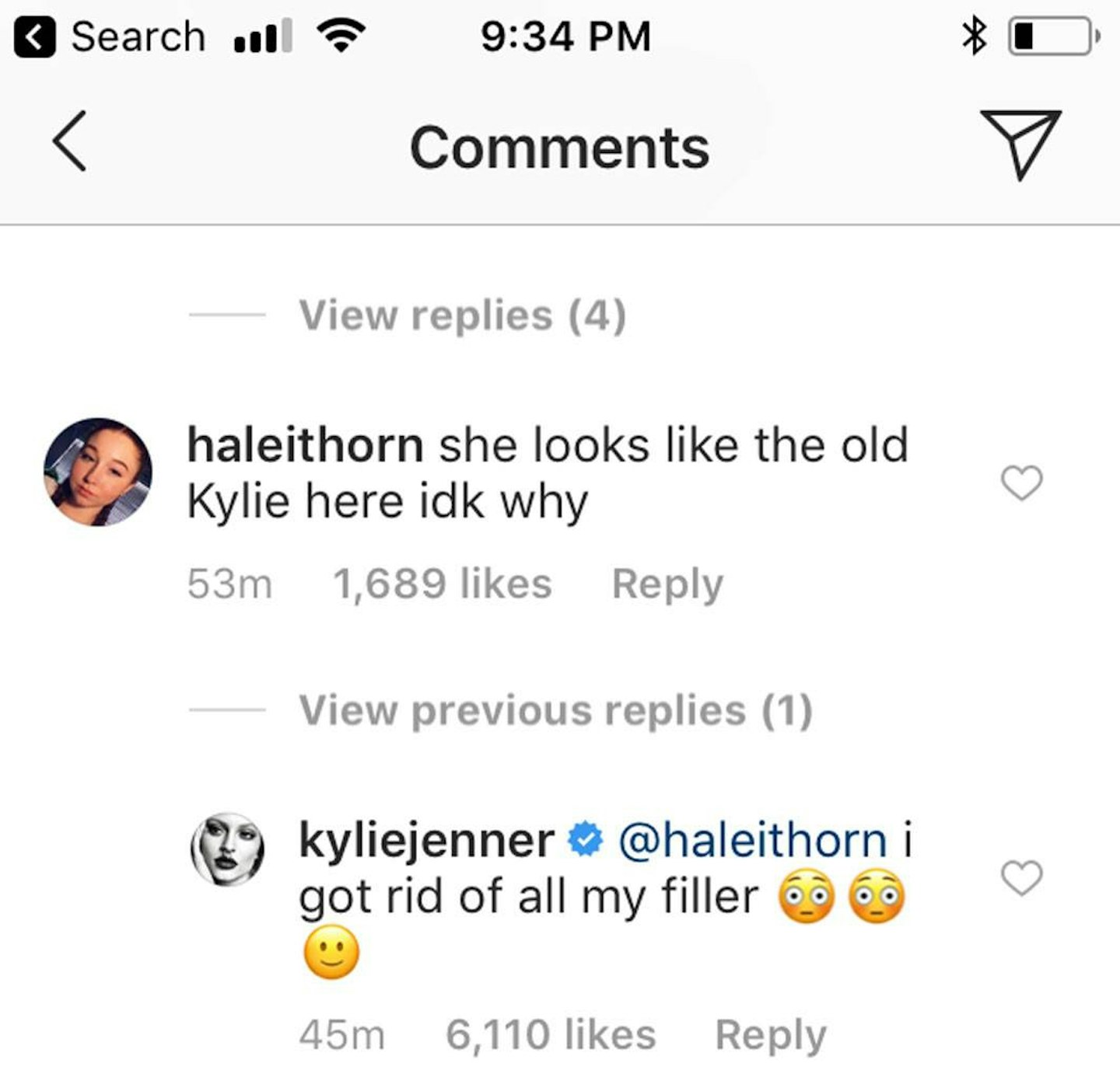 Kylie Jenner's lip fillers
