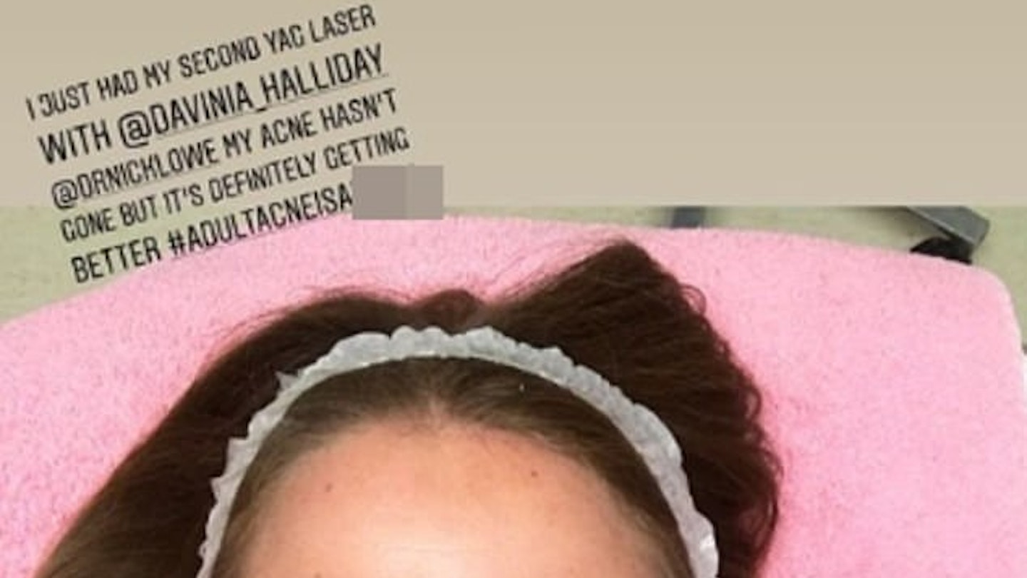 Millie Mackintosh shares adult acne celebrity skin solution on Instagram