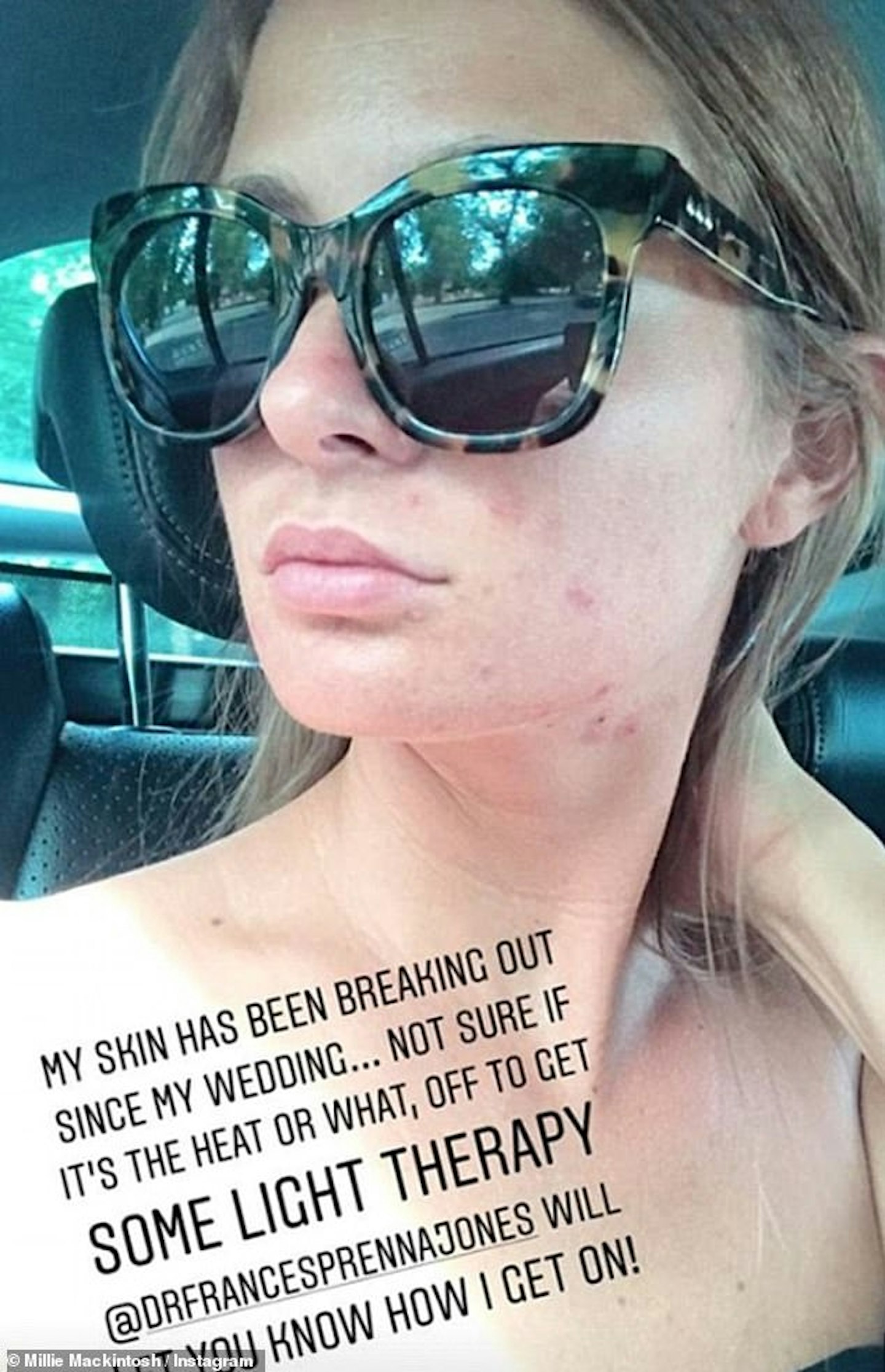 Millie Mackintosh shares adult acne celebrity skin solution on Instagram