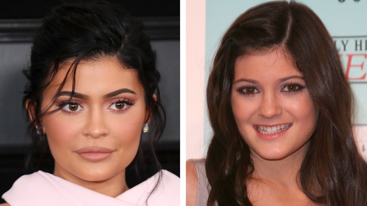 kylie jenner before after plastic surgery