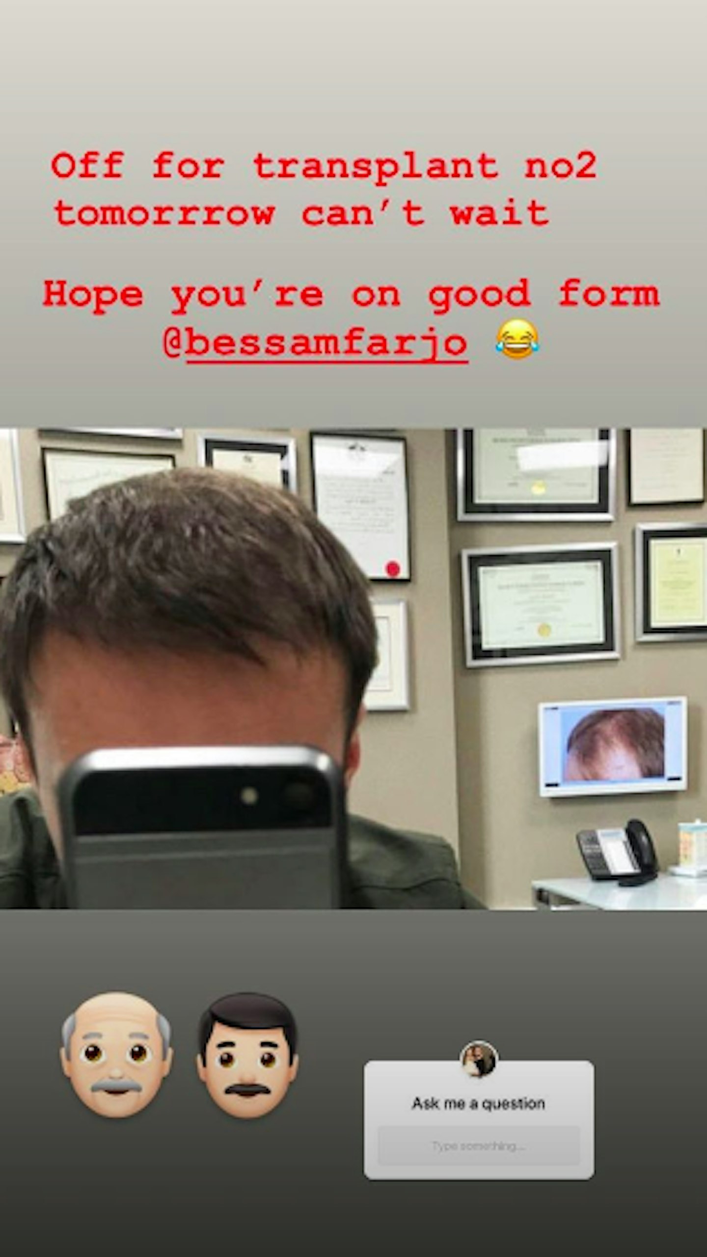 Alan Halsall hair transplant