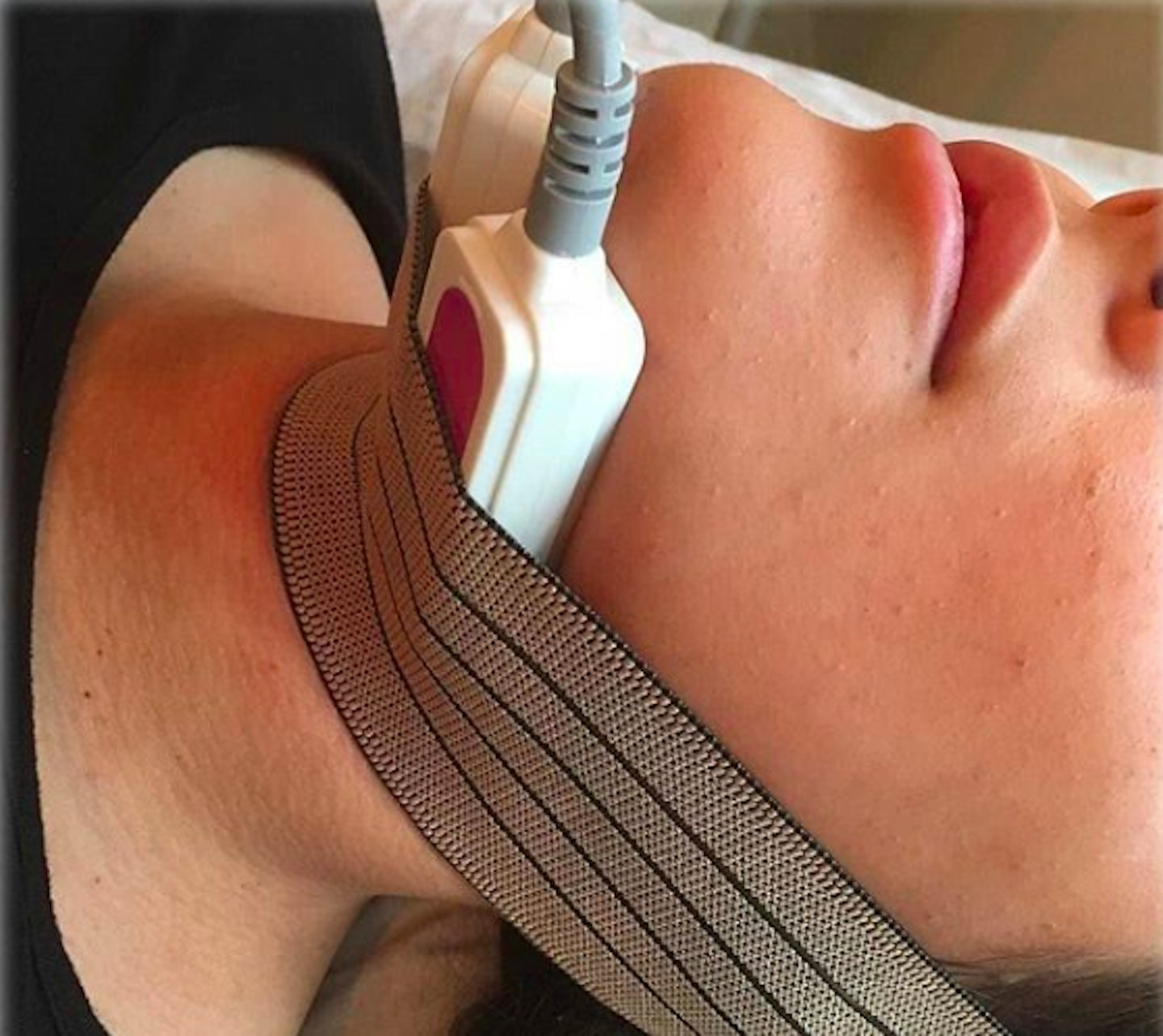 double chin treatment