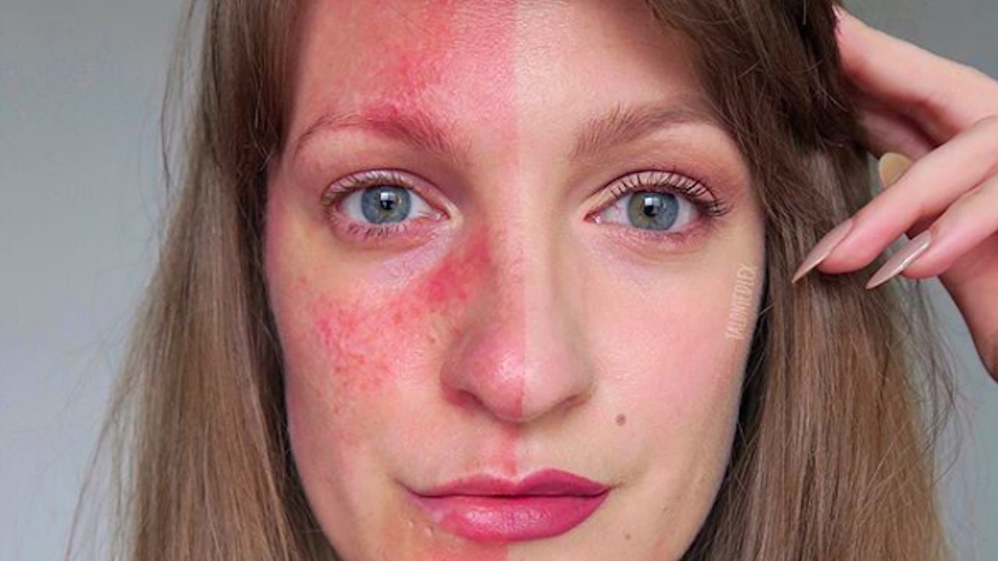 @talontedlex pictured with her rosacea half-covered by makeup 