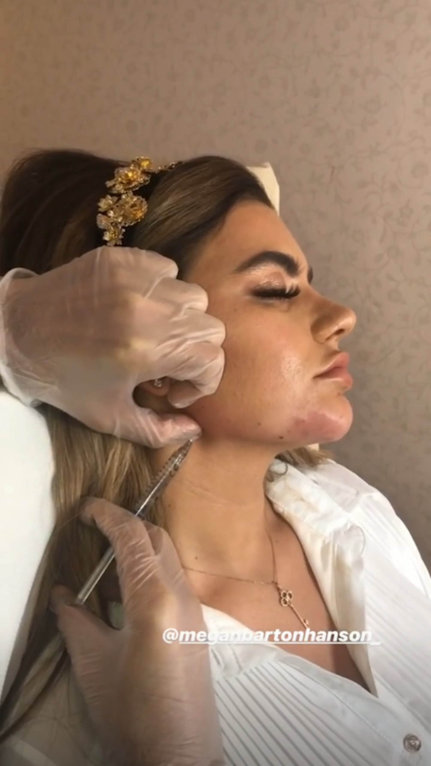 megan barton hanson jaw filler