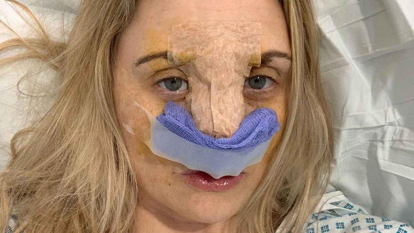 Carla Bellucci  NHS nose job