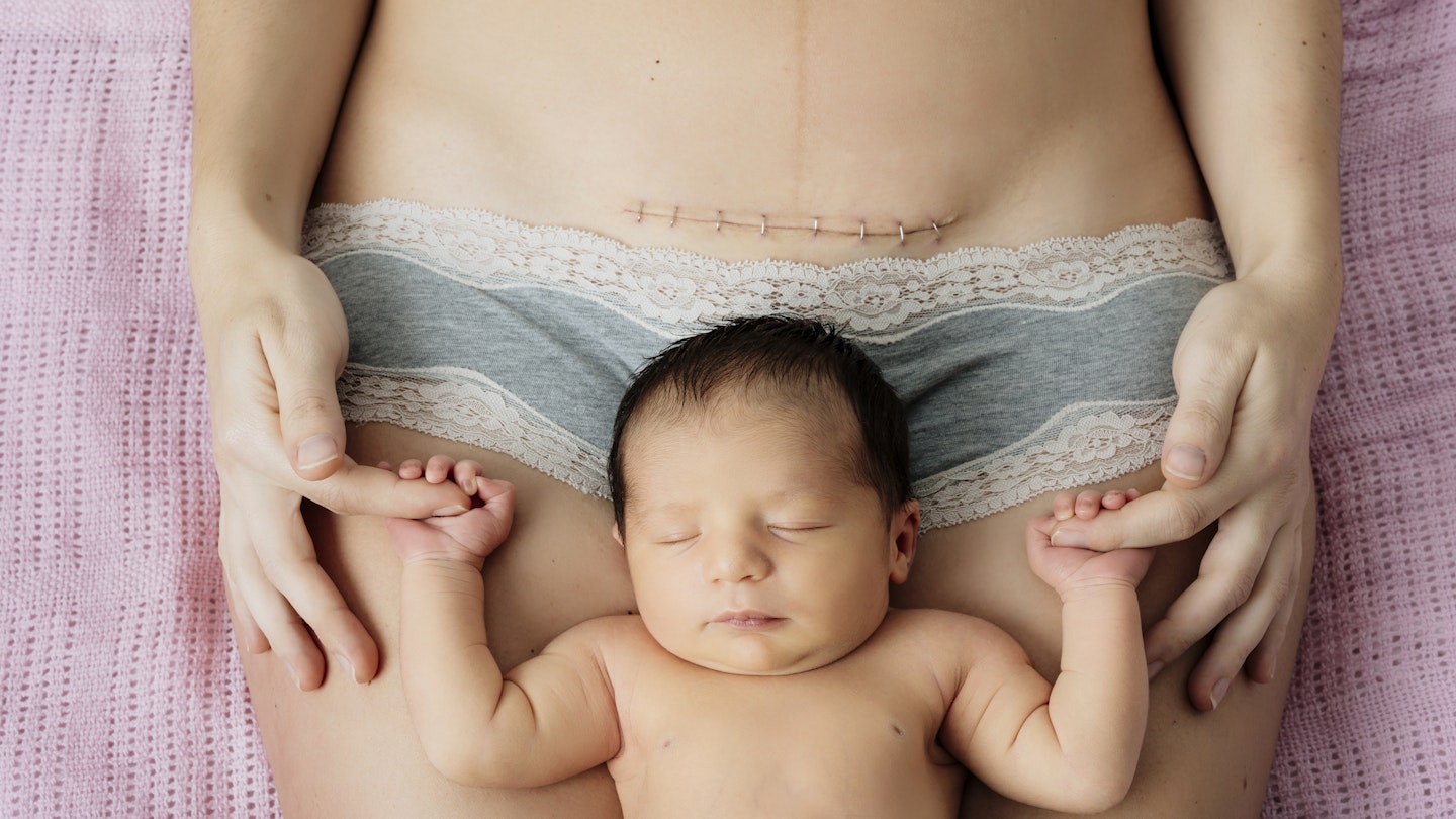 You Are Entitled To A C-Section If You Want One - Here's How To Get One