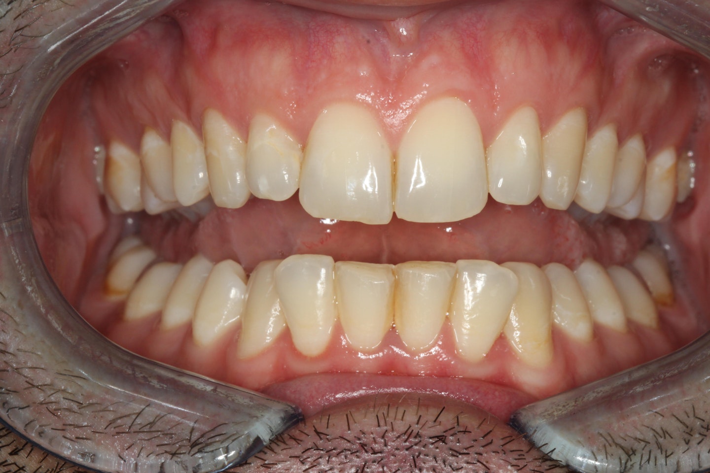 Before teeth whitening