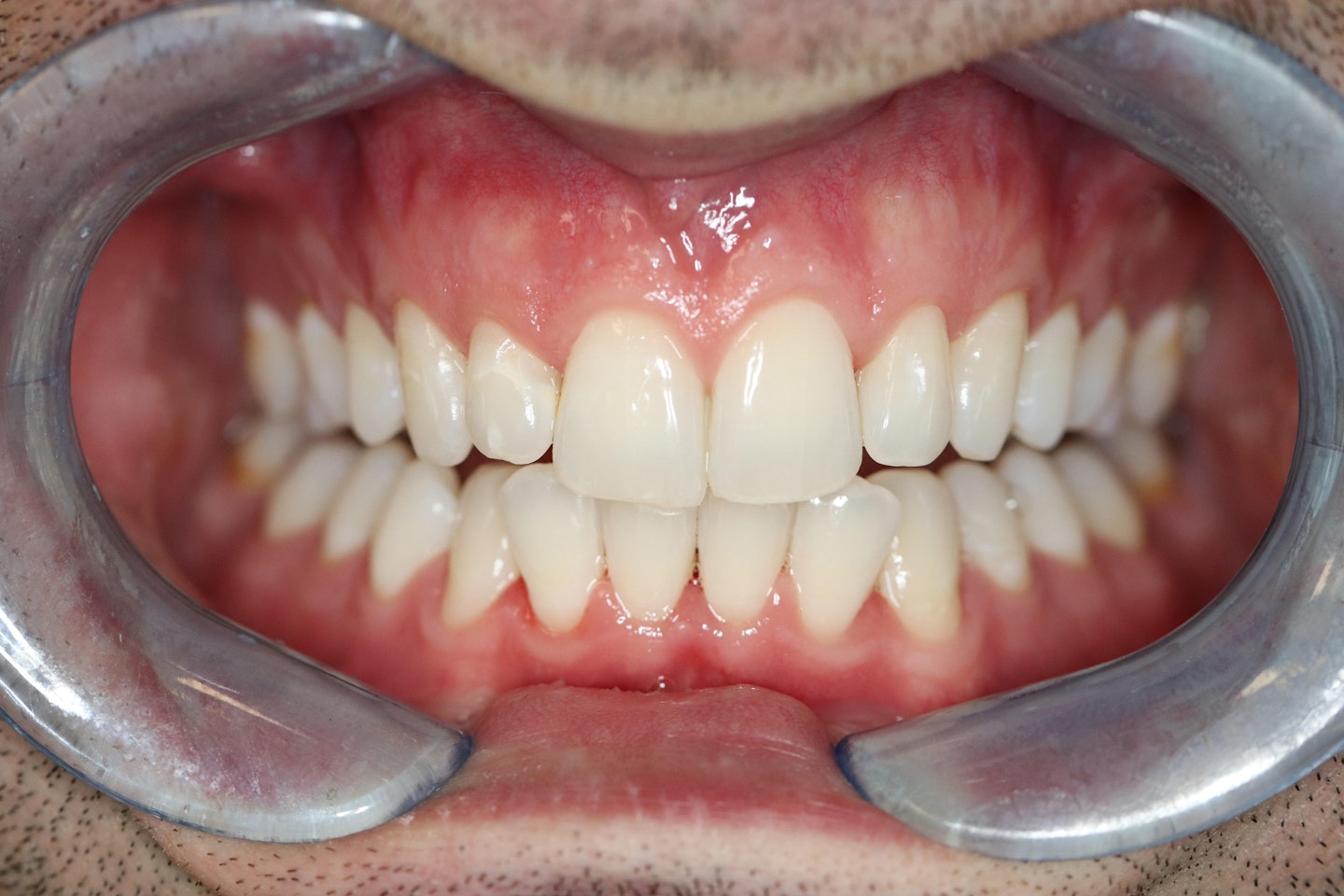 After teeth whitening