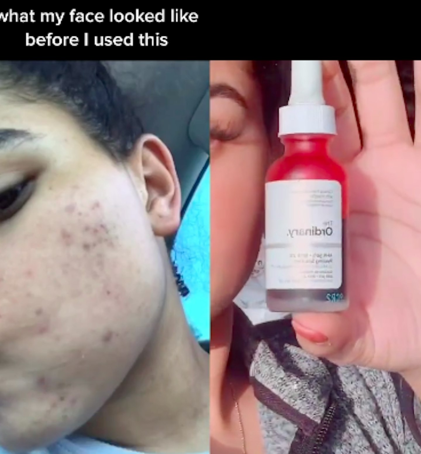 the ordinary product acne