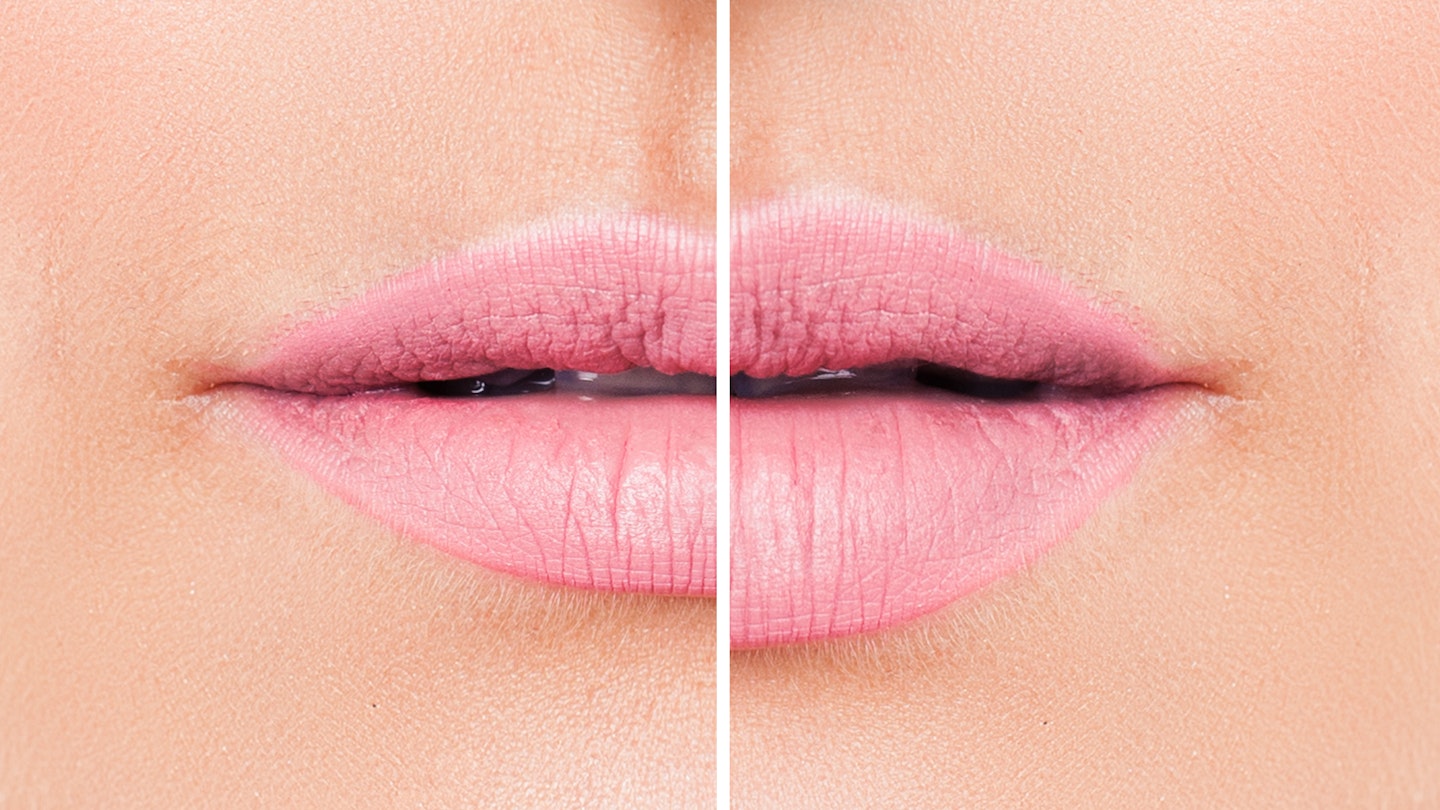 Everything You Need to Know Before You Get a Lip Flip - Prime Women