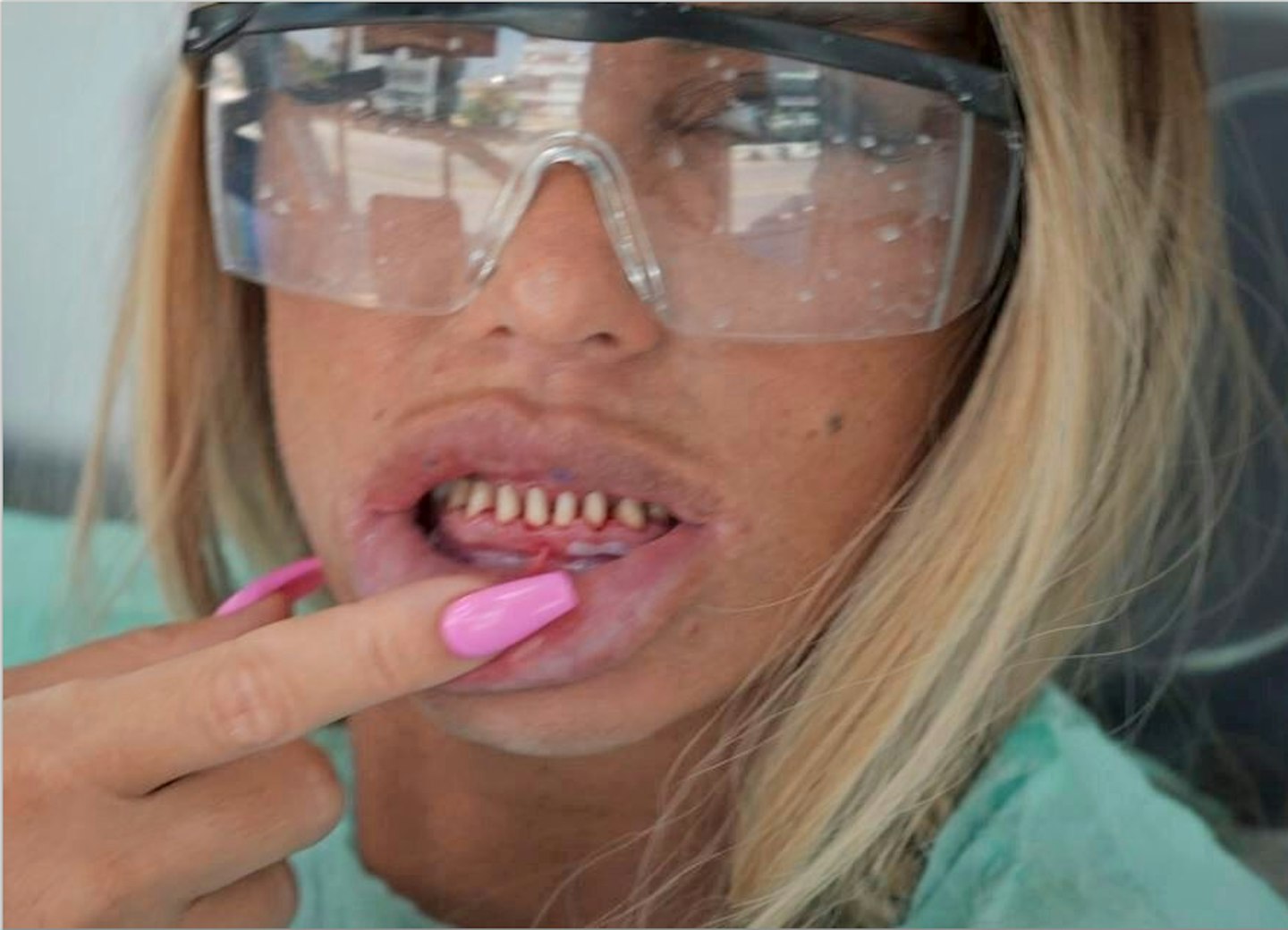 Katie Price teeth