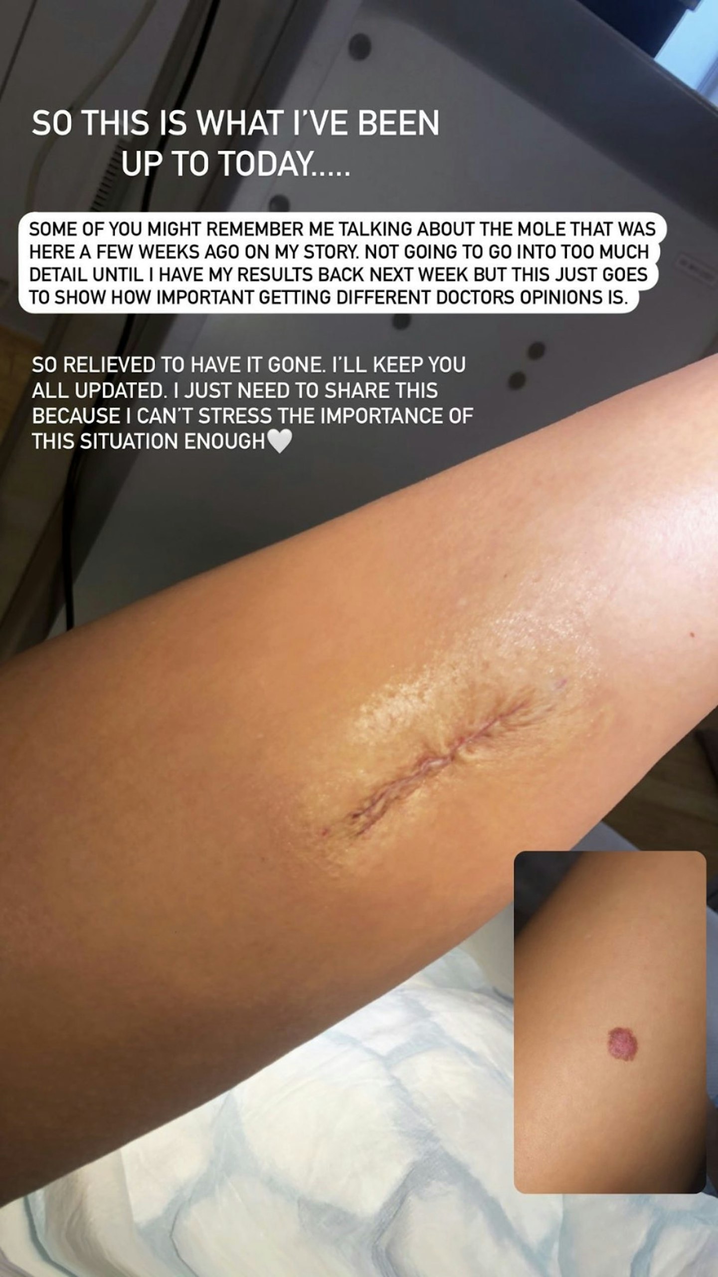 Molly-Mae Hague mole removal