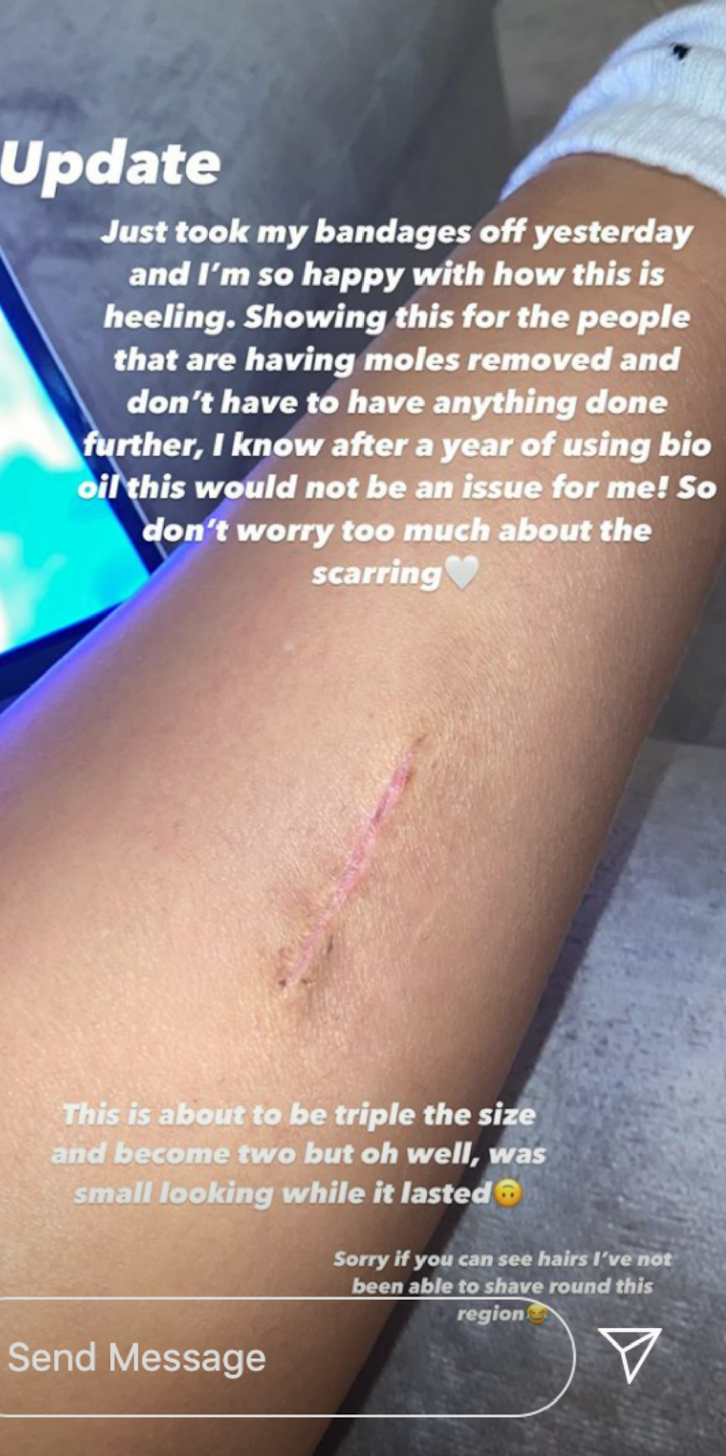 Molly mae hague's surgery scar