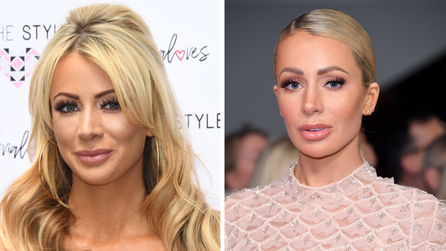 olivia attwood before after surgery