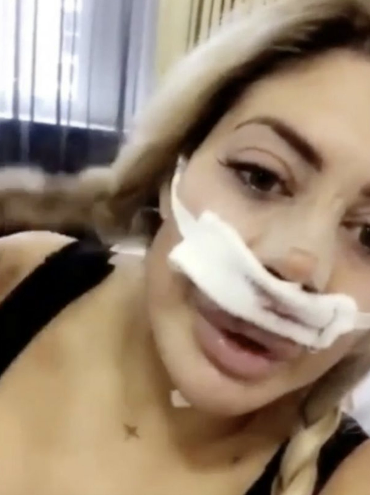 Chloe Ferry nose job