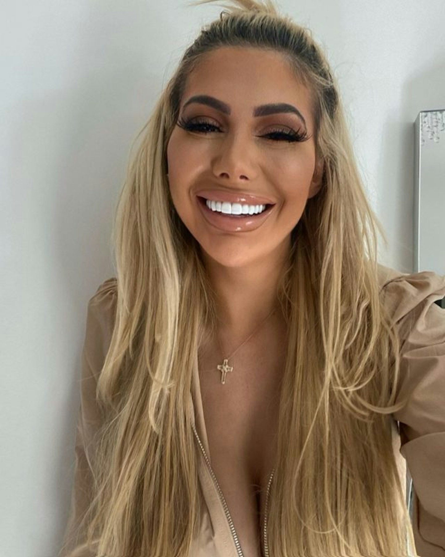 Chloe Ferry veneers