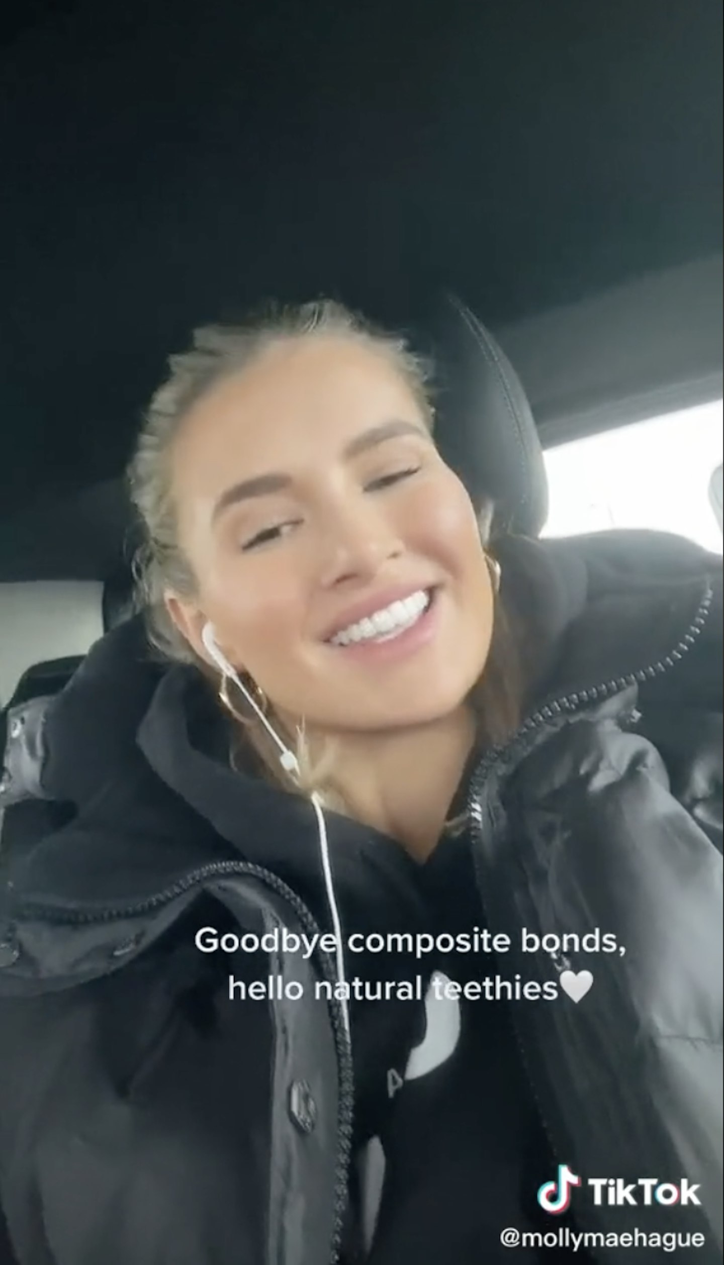 molly mae hague composite bonding removed