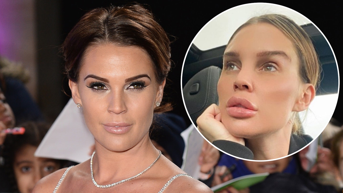 danielle lloyd before after surgery