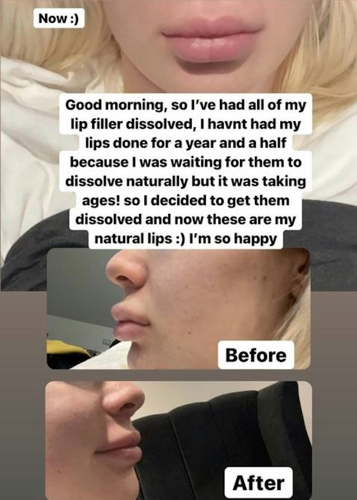 Demi Sims lip fillers dissolved