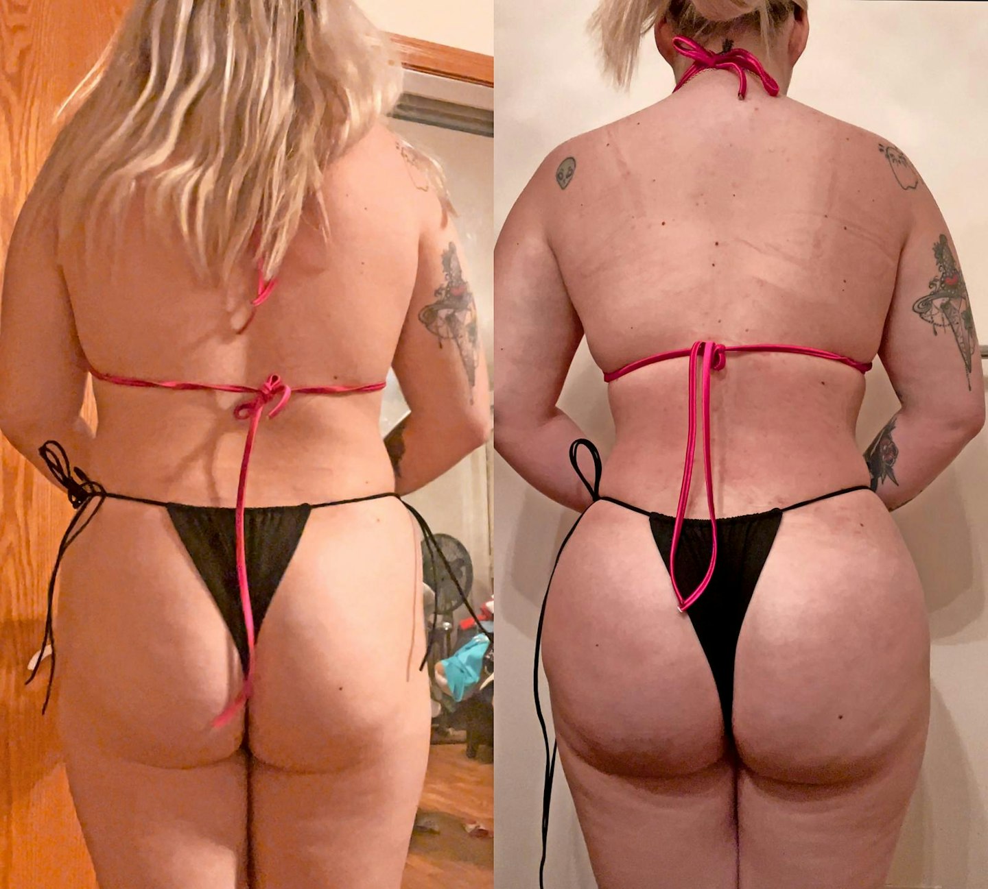 butt surgery before and after