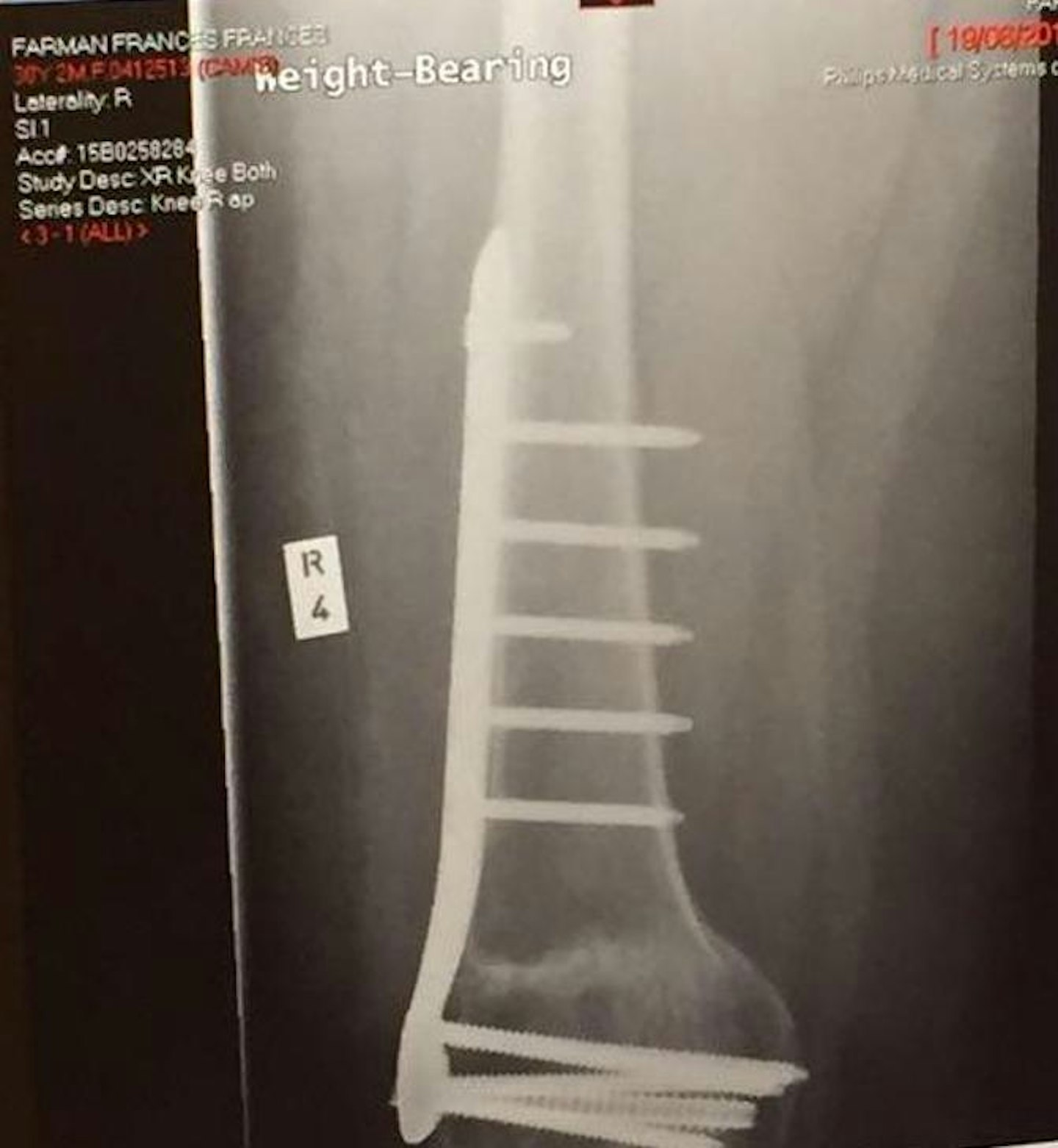 An X-ray of the metal rods in my leg