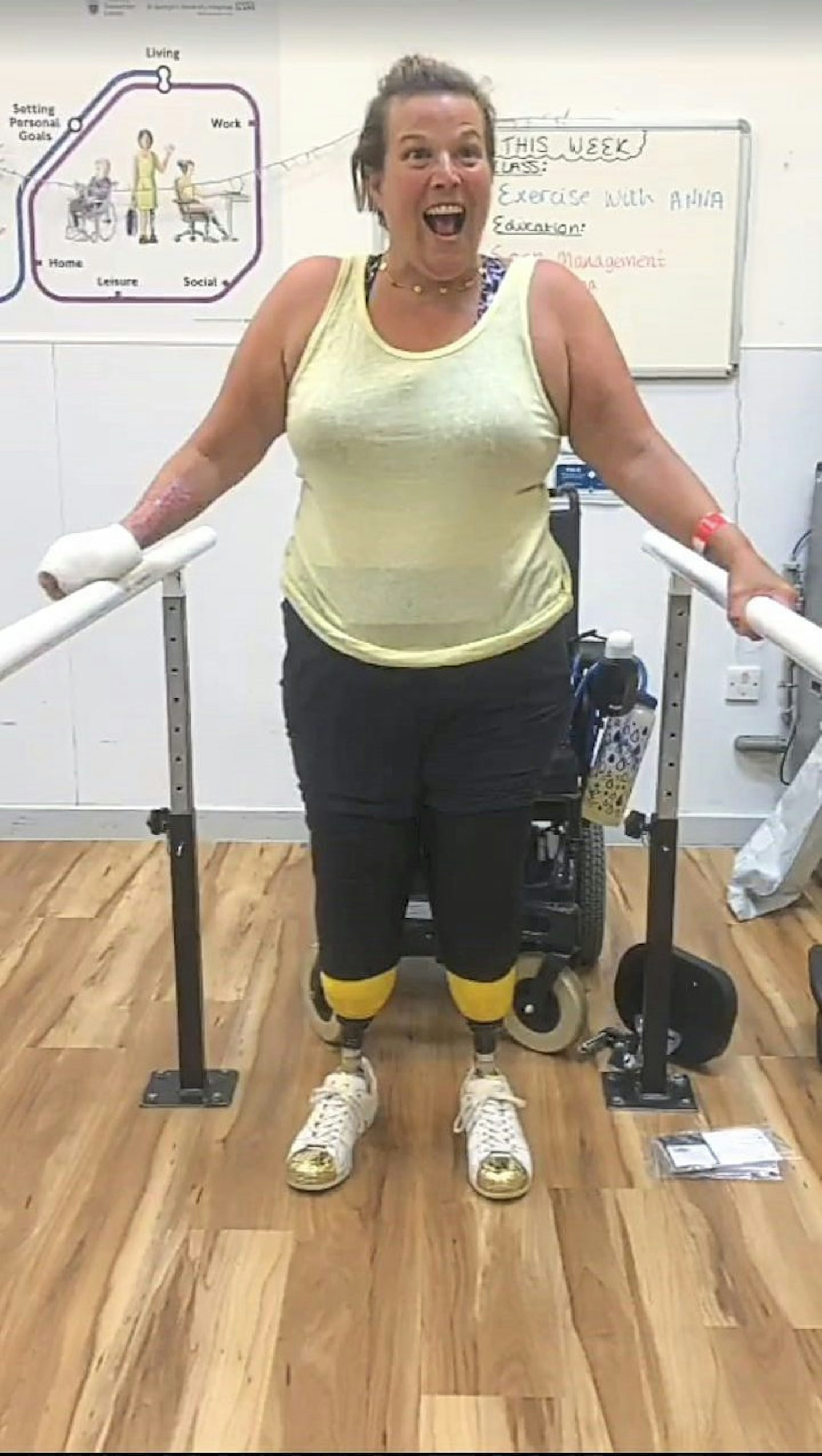 me in rehab getting used to prosthetics